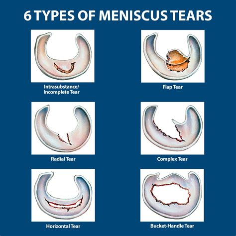 Grade 2 Meniscus Tear
