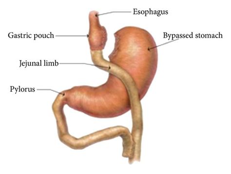 Roux En Y Gastric Bypass Surgery The Orientation Of The