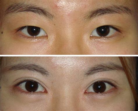 a modified method combining z epicanthoplasty and blepharoplasty to