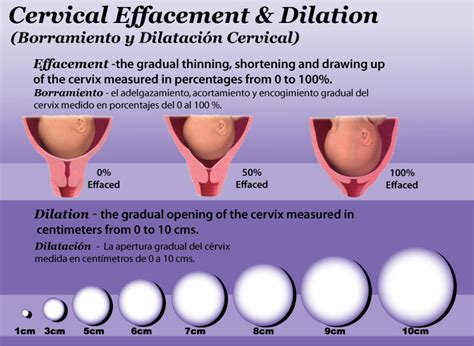 what does dilation look like and effacement cafemom