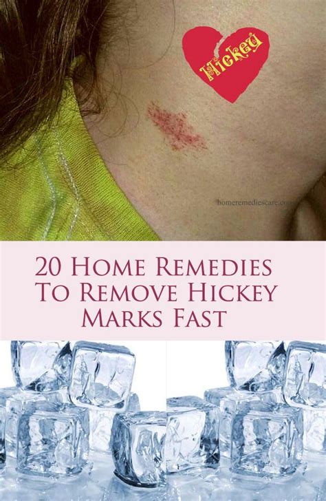 how to get rid of hickeys right now howtorem