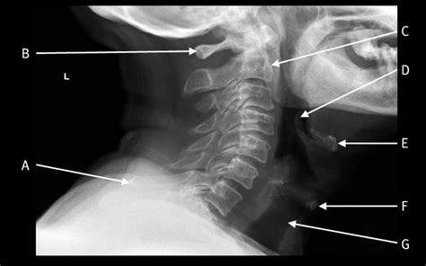 lateral plain radiograph   cervical spine  bmj