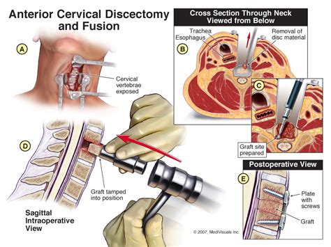 Decompression Anterior Cervical Decompression And Fusion