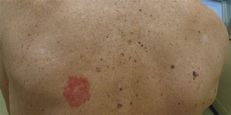 skin cancer symptoms pictures  types signs melanoma
