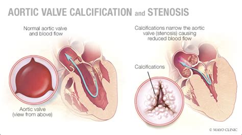Aortic Calcification An Early Sign Of Heart Valve Problems Mayo