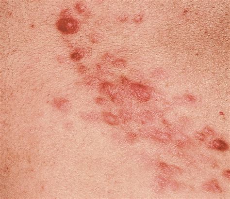 multiple painful cutaneous nodulesquiz case dermatology jama