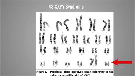 48 Xxyy Syndrome Youtube
