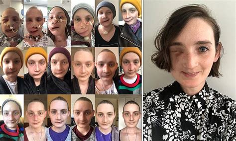 woman whose face was rebuilt to remove cancer reveals it returned when