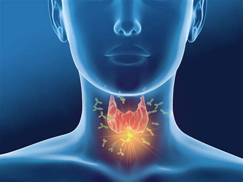 hashimoto s thyroiditis an autoimmune disease that leads to