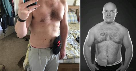 Men With Ibd Answer Questions On What It S Like To Live With A Stoma