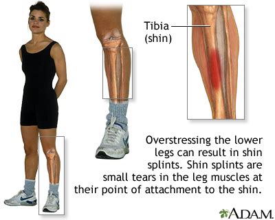 leg pain information mount sinai  york