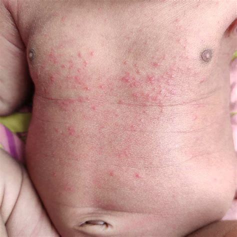 parentingclinic gd morning sir today morning    red rashes