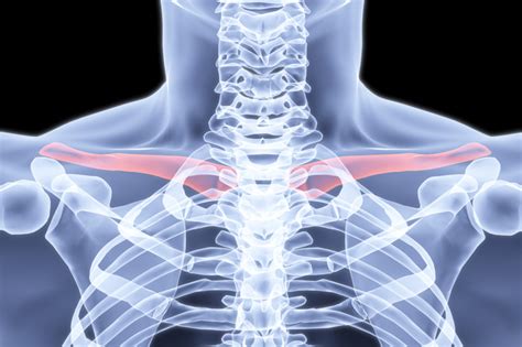 clavicle fracture doctor answers