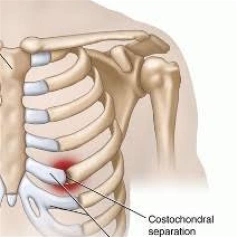 what is costochondral separation causes symptoms treatment