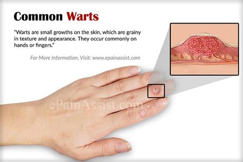 are common warts contagious symptoms treatment and home