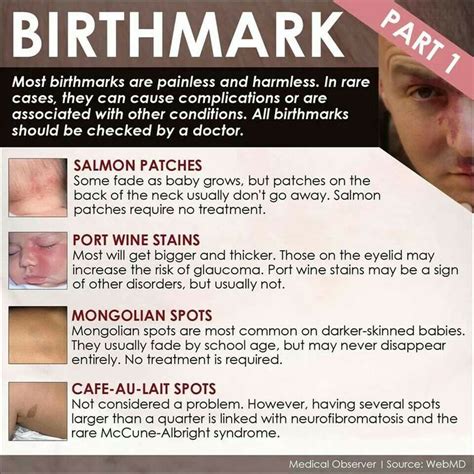 pin by autumn russell on rn port wine stain birthmark