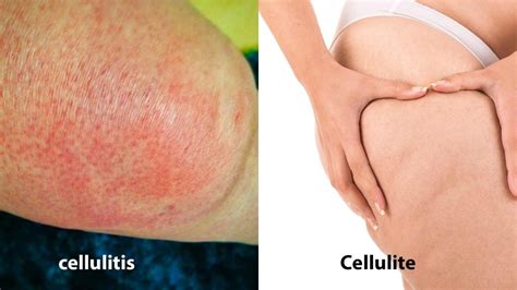 cellulitis 6 fast facts that you should know