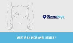 hernia images   hernia symptoms hernia exercises