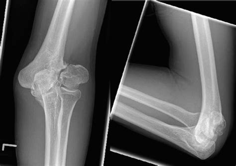 tardy ulnar nerve palsy   neglected childhood lateral epicondyle fracture  union
