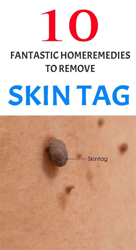 top 10 home remedies to remove skin tags naturally wellness and remedy