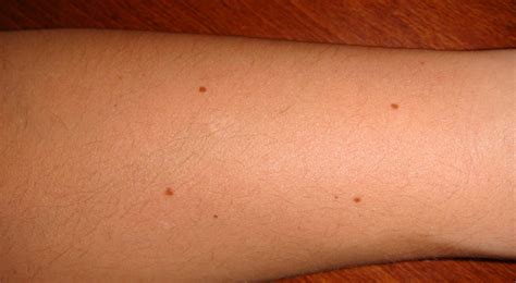 Numbers Of Moles On Arm Predicts Skin Cancer Risk Jasarat