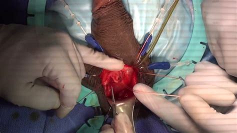very long very straight penile implant youtube