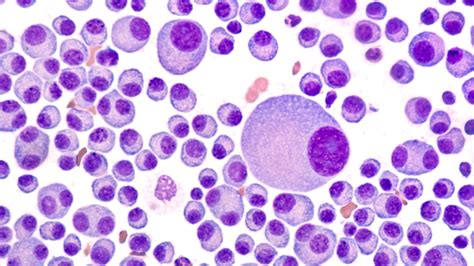 study finds drug therapy  delay onset  myeloma symptoms mayo