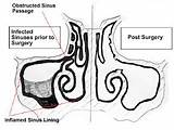 Sinus Sinusitis Surgery Fess Endoscopic Endoskopi Mengobati Bagaimana Polip Operasi Bedah Fungsional sketch template