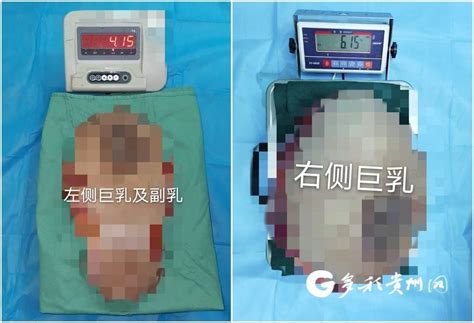 贵州12岁女孩长出巨大乳房 切除后双乳重达20斤 搜狐大视野 搜狐新闻