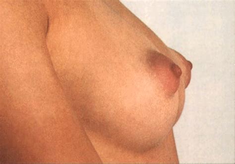 breast buds in girls