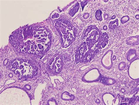 Endometrial Poorly Differentiated Serous Adenocarcinoma Of