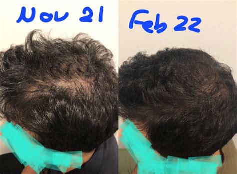 How Do You Know If You Need Minoxidil Is Finasteride Enough Hairloss