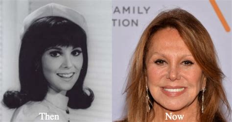 Marlo Thomas Plastic Surgery Before And After Photos