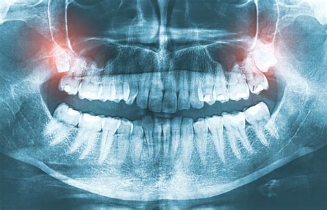 dont  wisdom teeth removed bixby knolls dentist