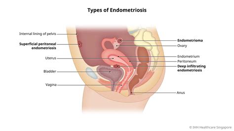 endometriosis symptoms  mount elizabeth hospital