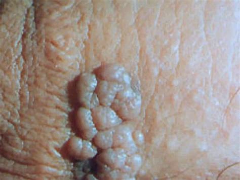 can you cure genital warts on your own stethnews