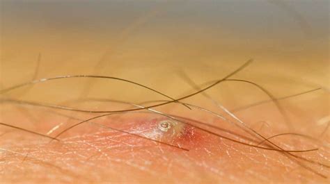 ingrown hair on penile shaft removal identification and causes