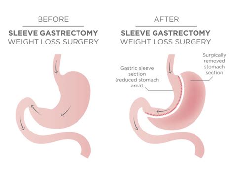 Gastric Sleeve Vs Gastric Bypass
