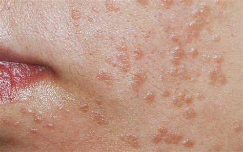 warts  face   remove moles warts skin tags safely