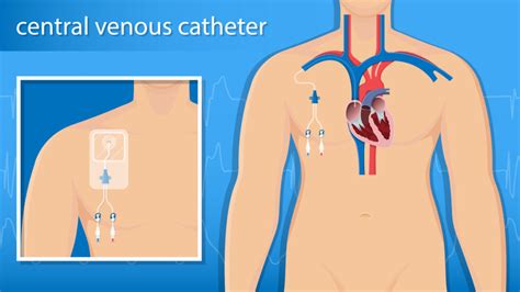 types  central venous catheters vascular wellness