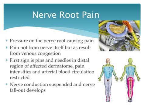 disc lesions nerve root pain powerpoint  id