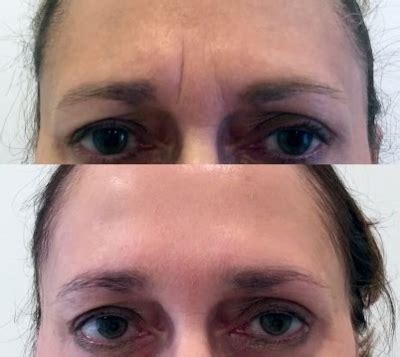eyebrow elevation sheraz plastic surgery