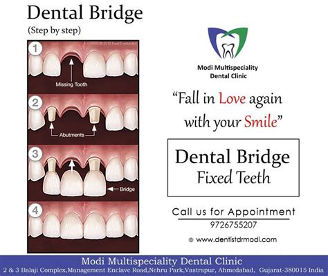 attractive dental bridge cleaning   dental bridge dental