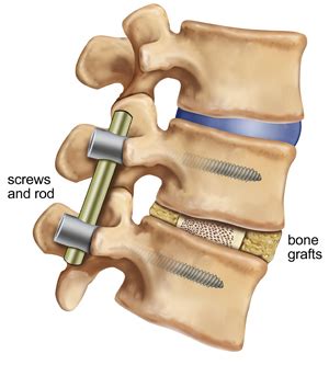 spinal fusion surgery  success virginia spine specialists
