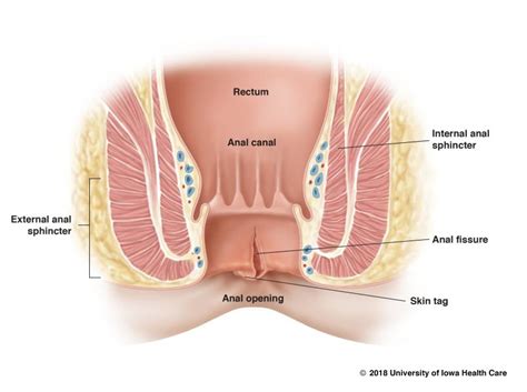 Treating Anal Fissures Without Surgery Variety Of