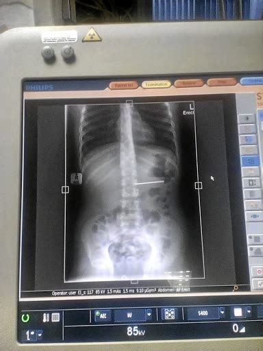 bullies force girl 9 to swallow sewing needle