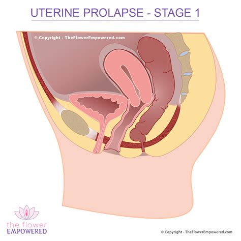Uterine Prolapse Prolapsed Uterus Pelvic Organ