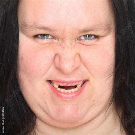 Obese Woman With Missing Teeth Stock 사진 Adobe Stock