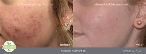 rediscover radiance   treatment phoenix skin spa