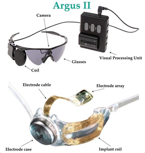 argus ii bionic eye implant medical science science  technology bionic eye content
